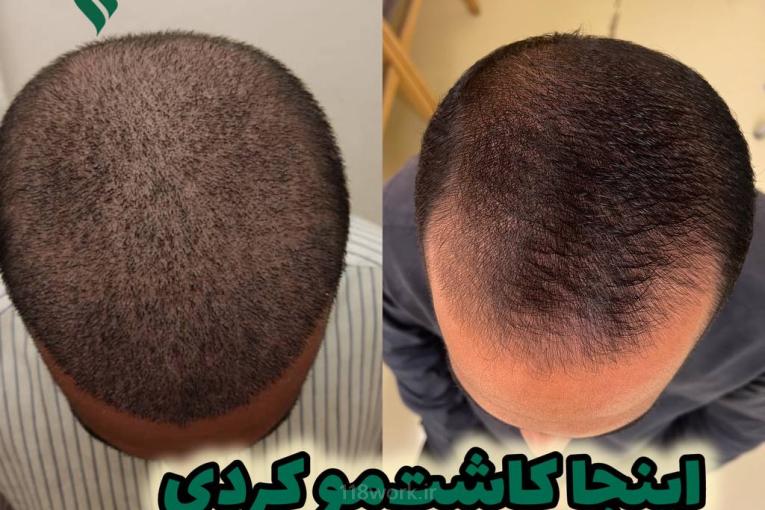 کاشت مو مینا وزیرزاده در شیراز