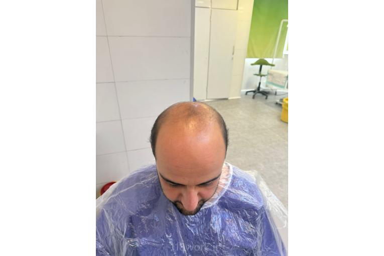 کاشت مو نادیا منصوری در شیراز