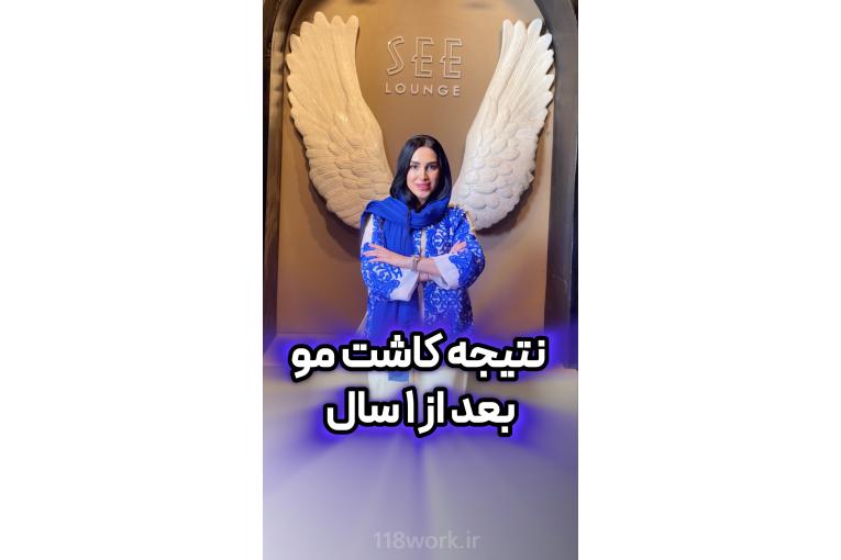 کاشت مو سمیرا حسینی در شیراز